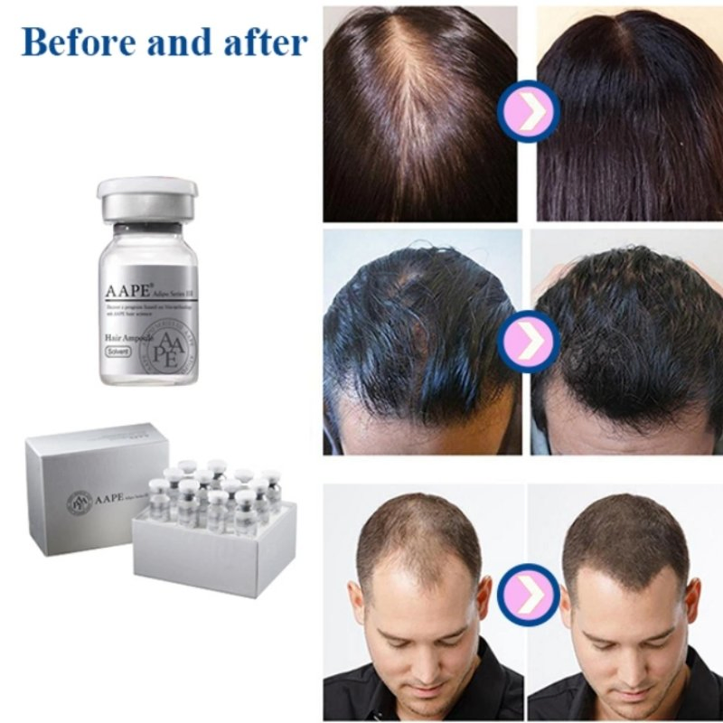 Aape Treatment of Hair Loss and Solve Scalp Problems Care for Hair Growth Treatment of Hair Loss