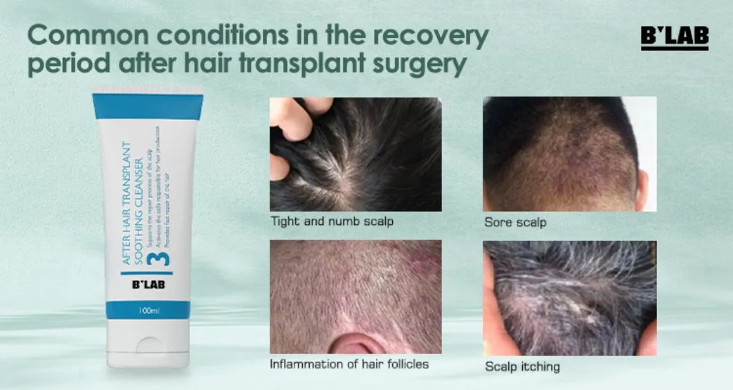 Hair Transplant Care 2