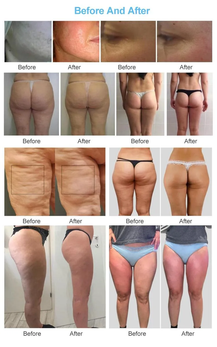 Resultados antes y después del tratamiento corporal y facial