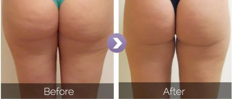 Antes y después del tratamiento 1