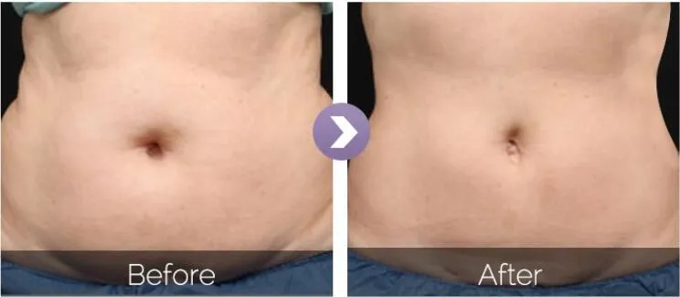 Antes y después del tratamiento 2