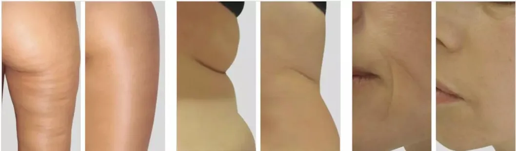 Antes y después del tratamiento 3