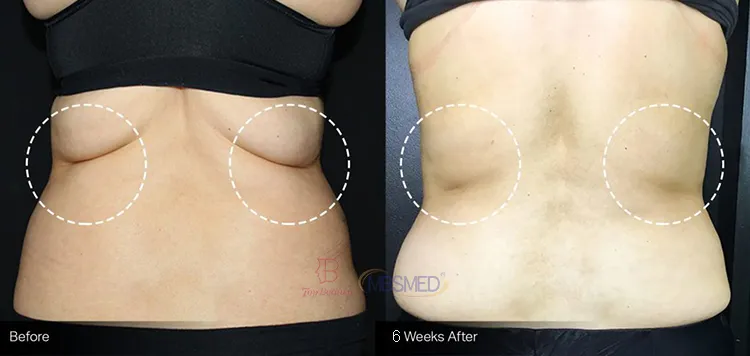 Levantamiento facial, modelado corporal, RF Tecar, radiofrecuencia Tecar, máquina de vacío Tecar