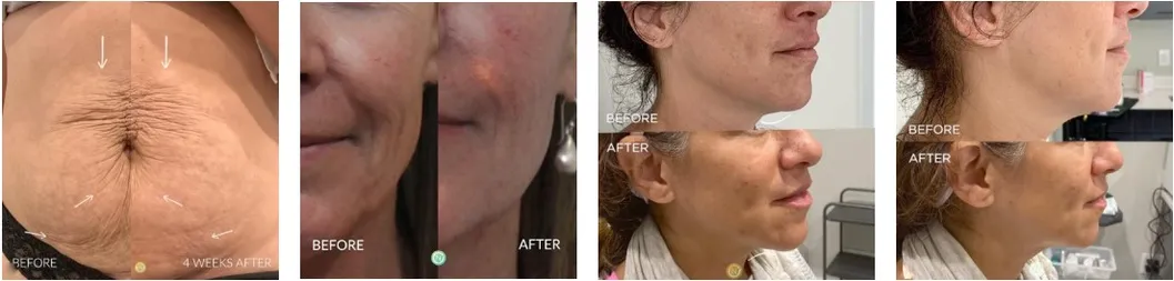 Antes y después