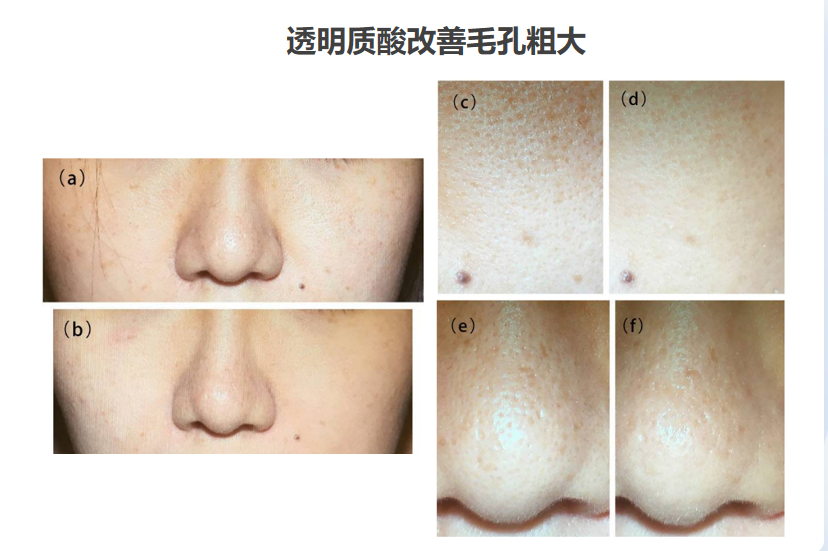 Premium Hyaluronic Acid Hydra Facial Serum Deep Hydration Repairing Skin Care Serum Private Label OEM/ODM