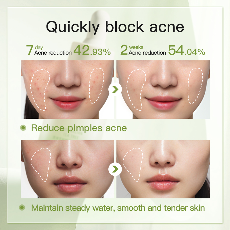OEM:Australian Tea Tree Oil Acne Serum Blemish Control Oil Control Pore Reducing Purifying For Oily Acne Prone Skin Face