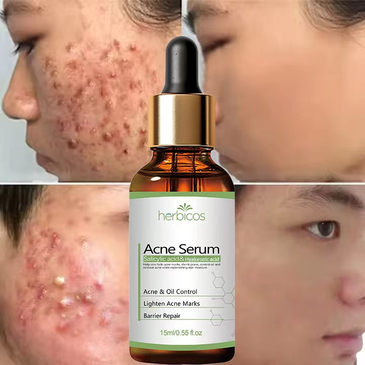 Private Label 2% Salicylic Acid Anti Acne Serum Oil Control Shrink Pores Repair Acne Scar For Oily Sensitive Acne Prone Skin OEM