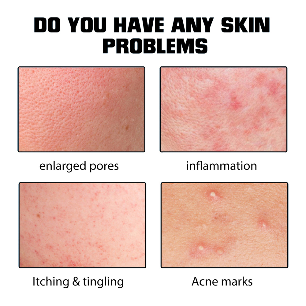 Private Label 2% Salicylic Acid Anti Acne Serum Oil Control Shrink Pores Repair Acne Scar For Oily Sensitive Acne Prone Skin OEM