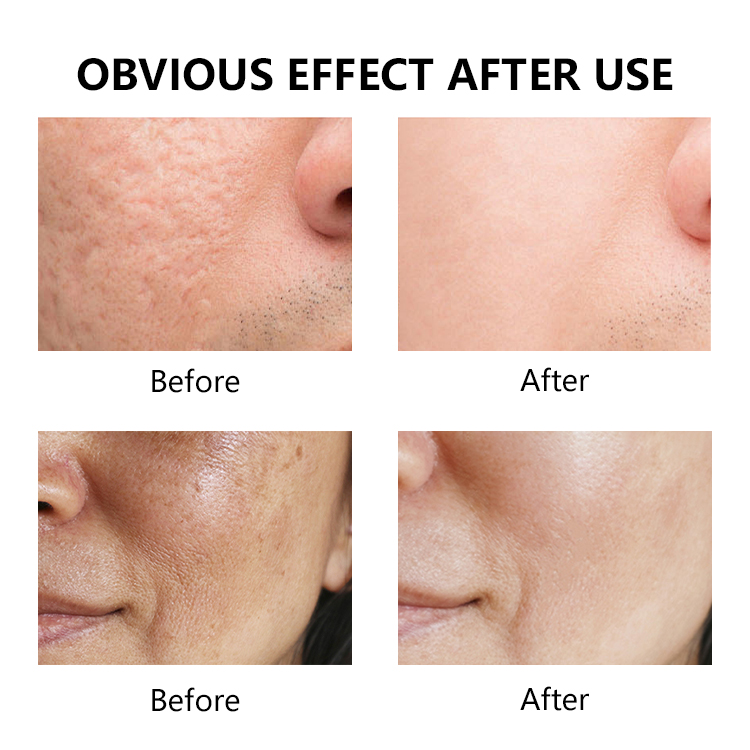 Private Label Oil Control Reduce Enlarged Pores &amp; Dark Spots Promotes Clear Skin Tone Azelaic Acid Serum