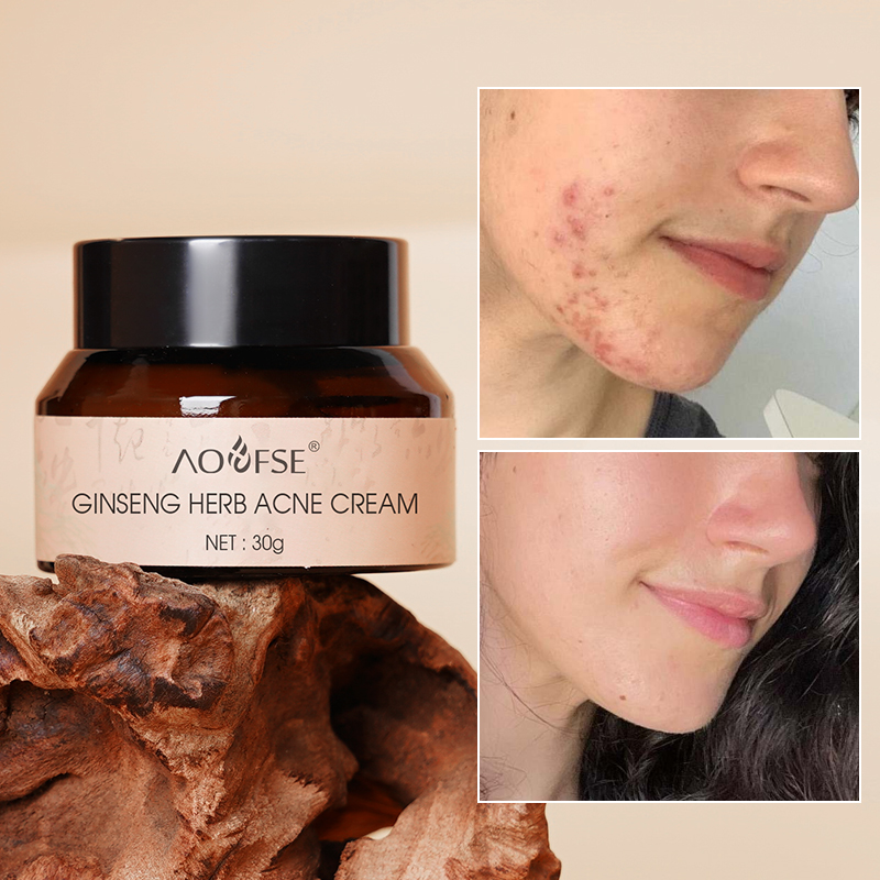 Herbal Night Cream Anti Acne Moisturizing Brightening Ginseng Skin Care Cream For Acne Scars