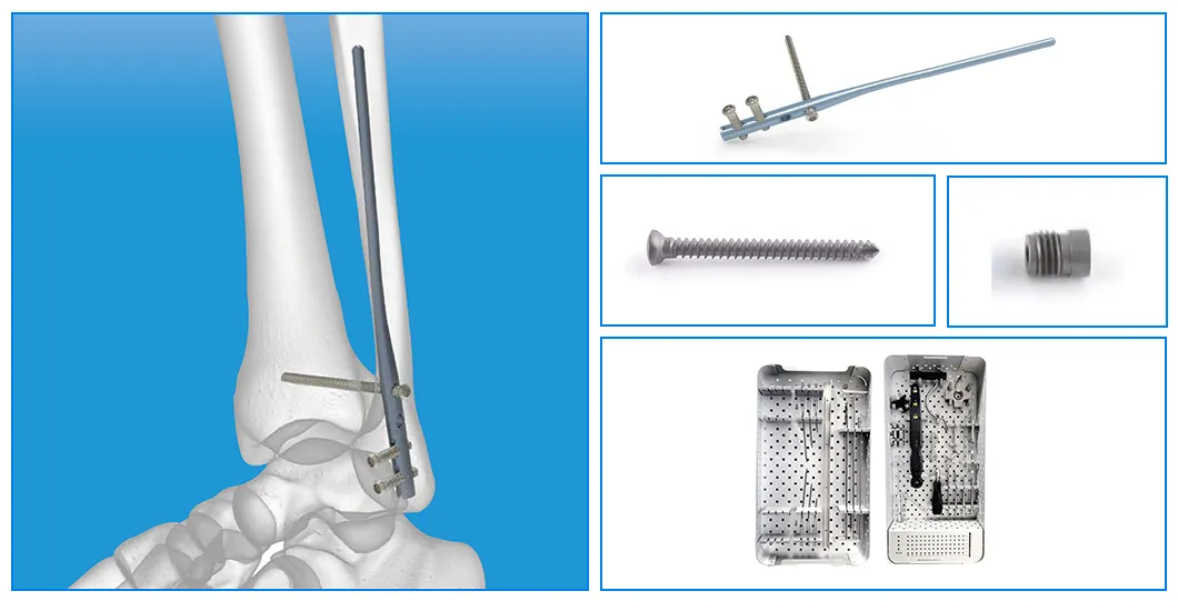 Fibular Nail Components