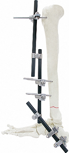 Professional External Fixator in White &amp; Black, Titanium Alloy for Bone Use