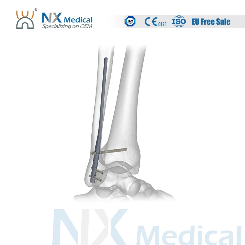 Orthopedic Implant Fibular Nail System Interlocking Intramedullary Nail