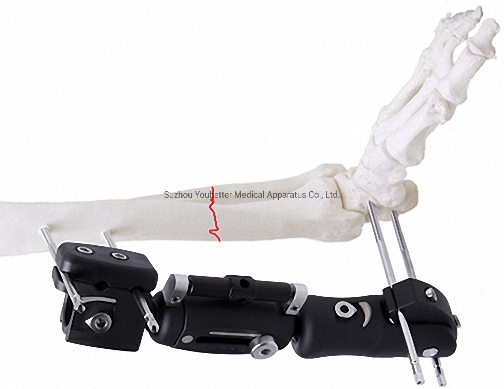 Professional External Fixator in White &amp; Black, Titanium Alloy for Bone Use