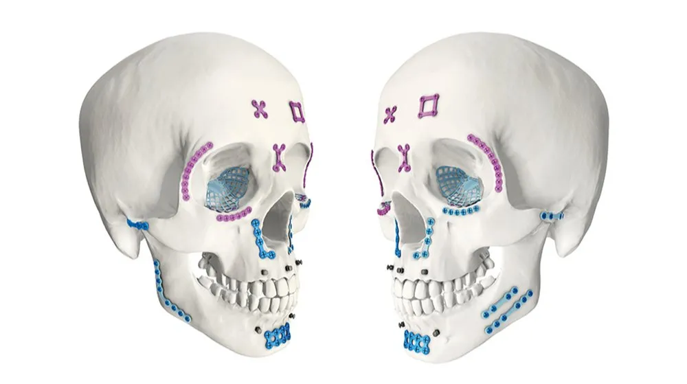 Orthognathic Surgery System