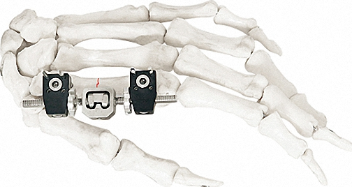 Professional External Fixator in White &amp; Black, Titanium Alloy for Bone Use