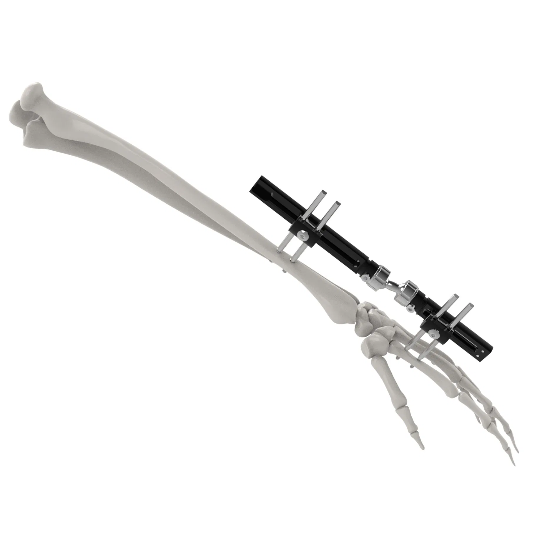 Canwell Small Bones Fracture Fixation Mini External Fixator Orthopedic Trauma Implant System for Phalanges and Metacarpals