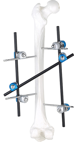 Orthopedic External Fixator for Bone Fractures