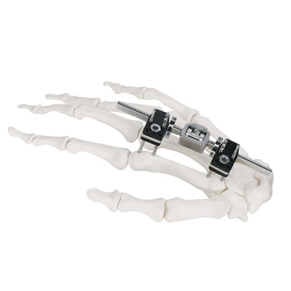 Finger Mini-Fixator 1