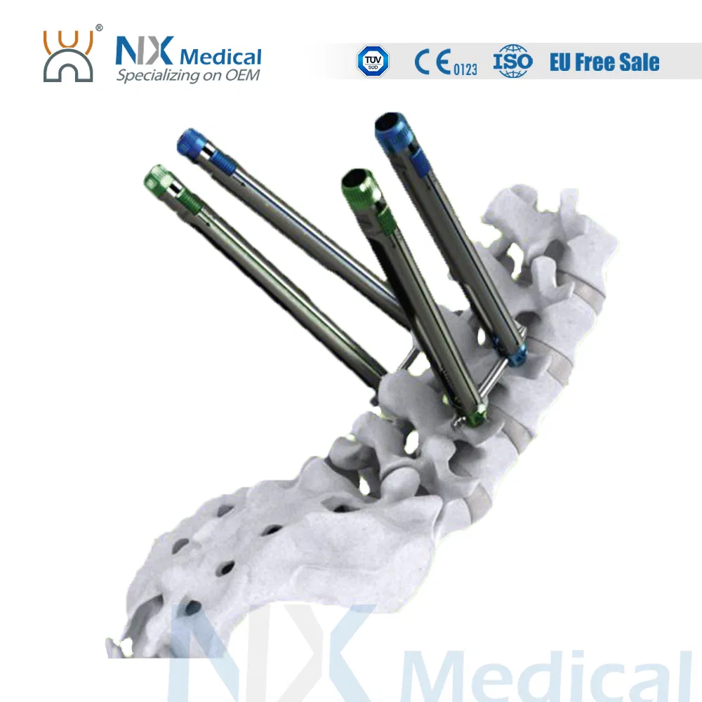 Nx Medical Sf-IV Mis Cannulated Bone Cement Spinal Pedicle Screw 5.5mm System