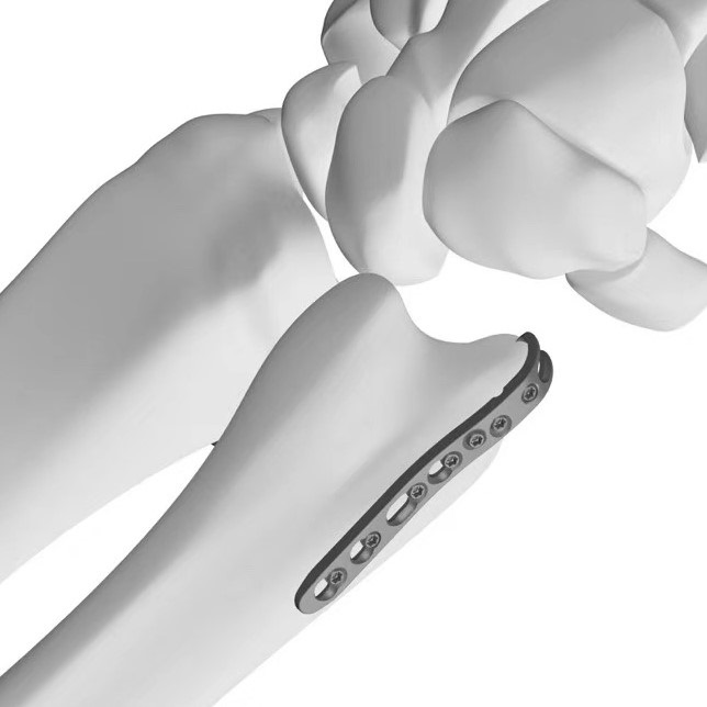 Orthopedic Distal Ulnar Hook Locking Plate, Medical Titanium Products