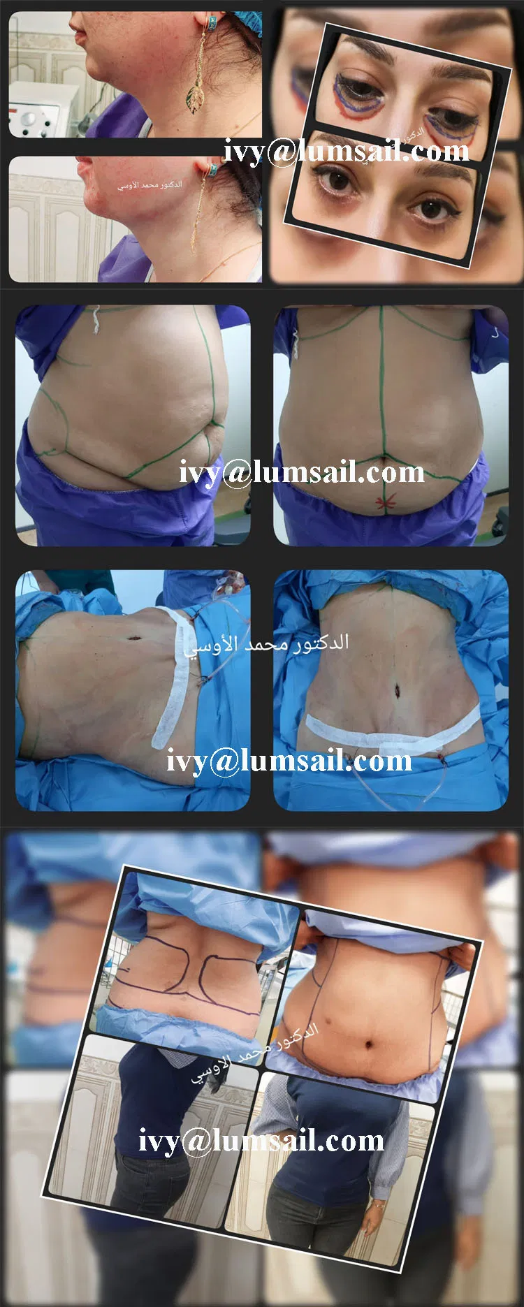 Resultados del Tratamiento de Liposucción