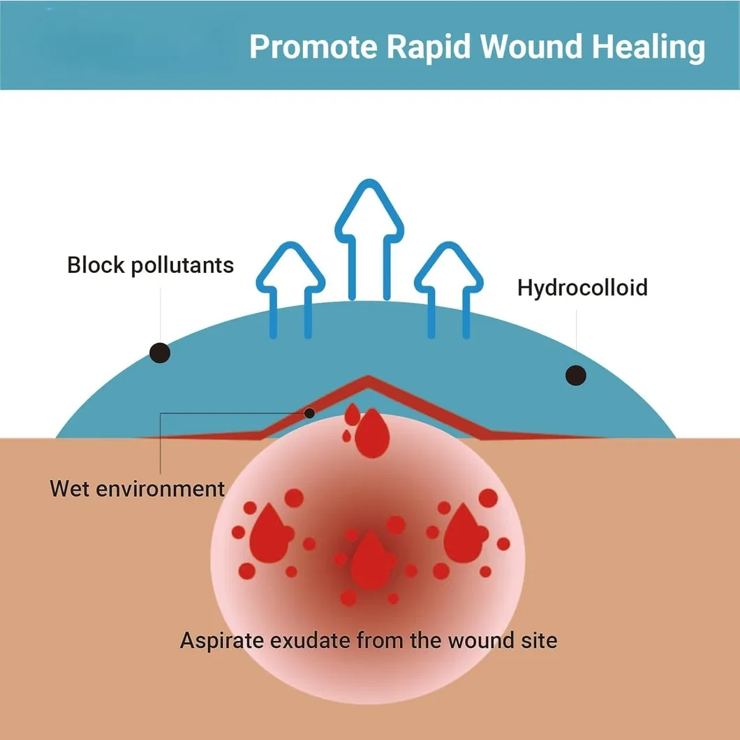 Hydrocolloid Dressing Application