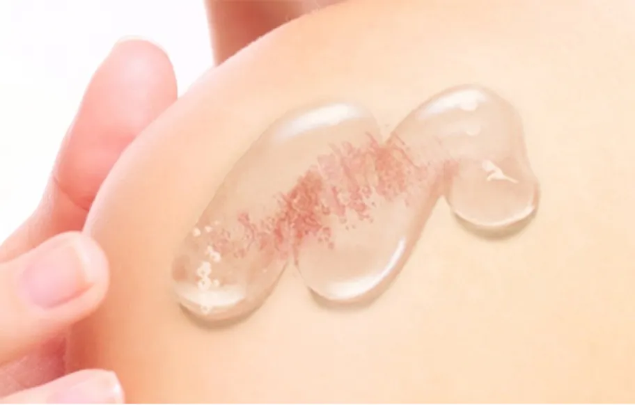 Application of Burn Gel