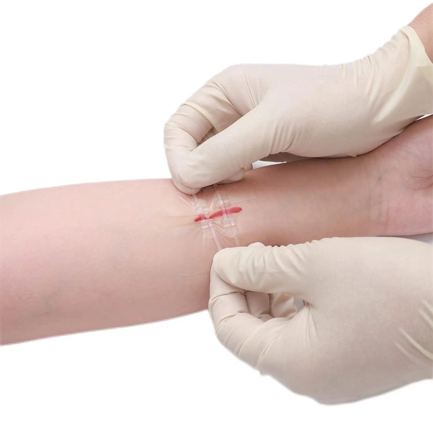 Quick Clot Zip Sutures Laceration Kit Surgical Quality Laceration Repair Kit Without Stitches