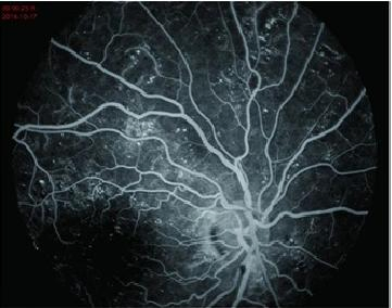 Hospital Ophthalmic Instrument Optical Fundus Camera Fluorescein Angiography System