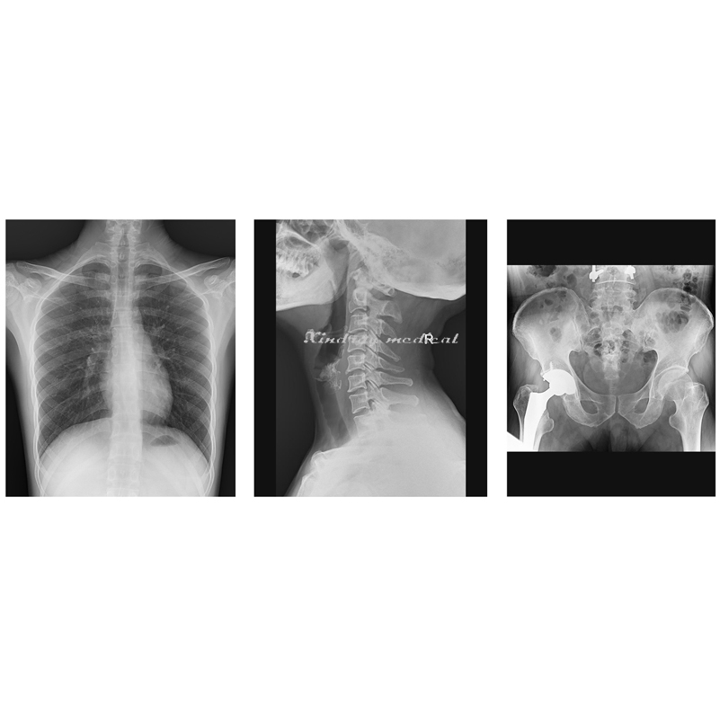 with Cheap Price Urinary System Angiography Drf 1000mA X-ray Machine