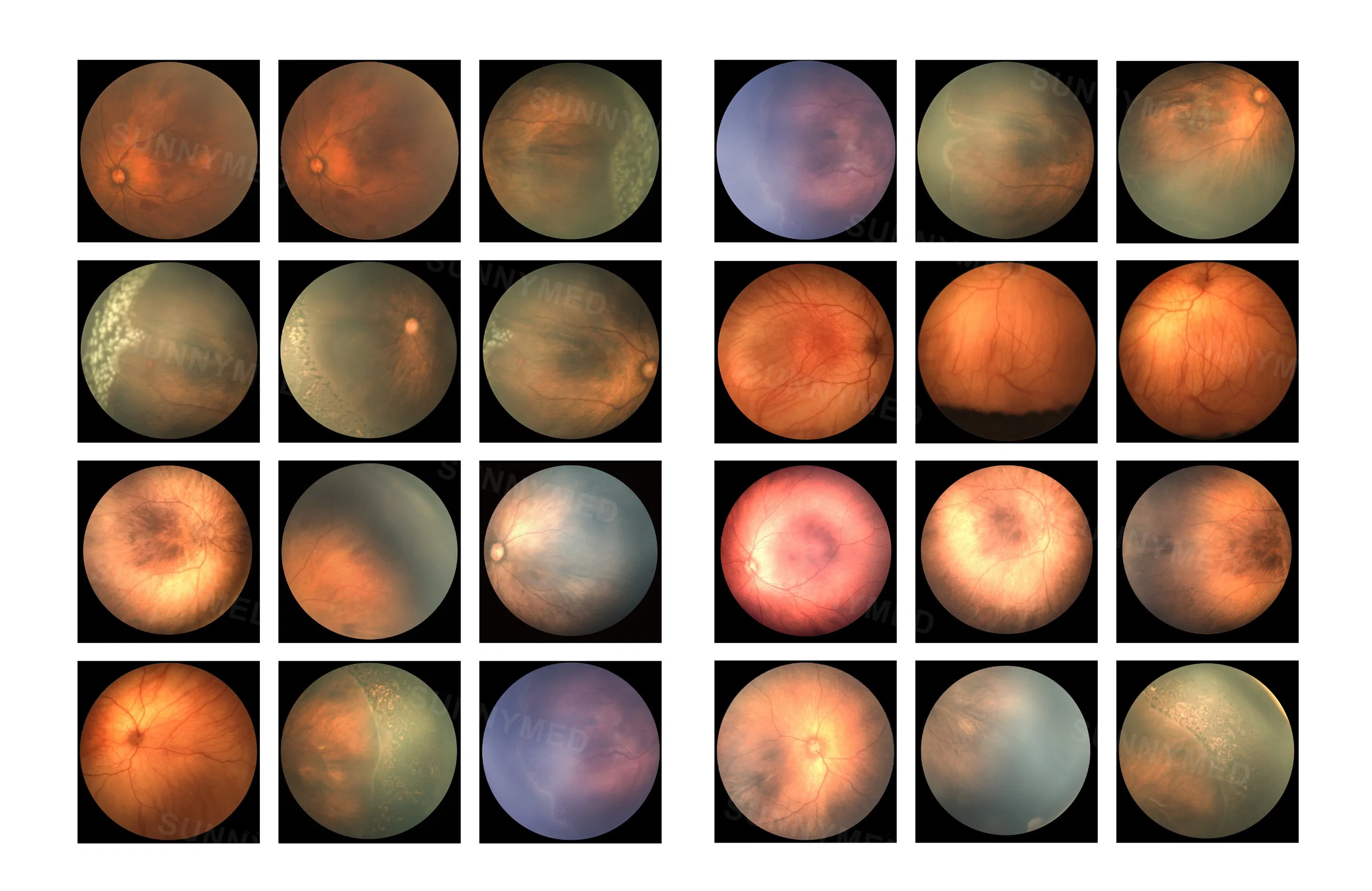 Sy-V095 Pediatric Wide Field Color Retinal Camera with Built-in Fluorescein Angiography