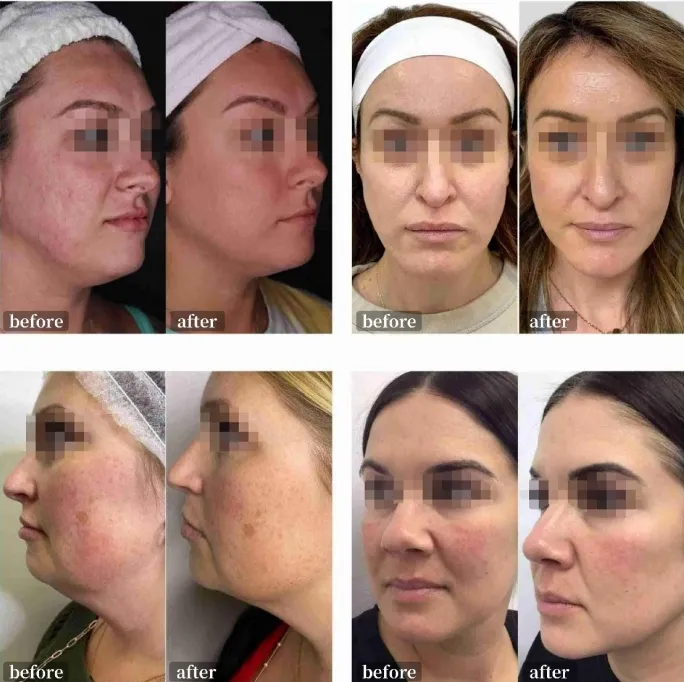 Ice Gold 2 Handles Wrinkle Removal Skin Tightening Anti-Aging RF Microneedling Machine