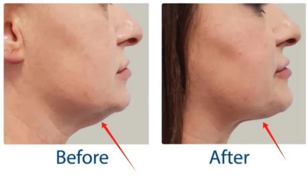 Before and After 1