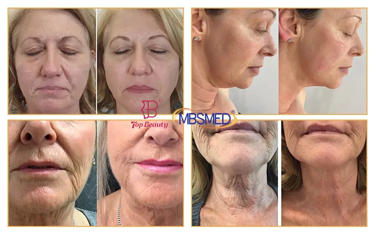 Hifu Before and After