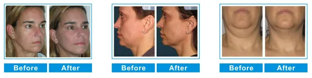 Professional Hifu Maquina Device for Face Lifting Anti-Aging Wrinkle Removal