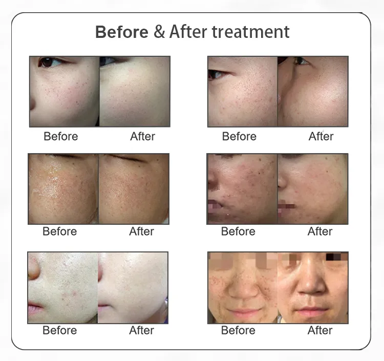 DPL Treatment Screen