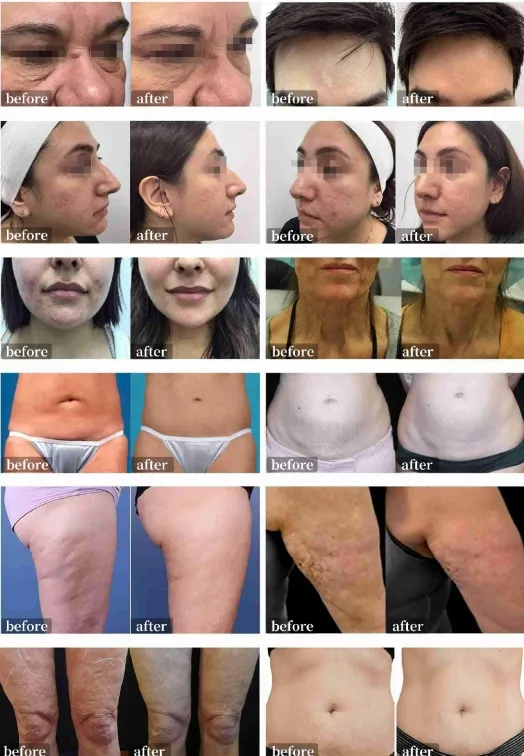 Ice Gold 2 Handles Wrinkle Removal Skin Tightening Anti-Aging RF Microneedling Machine