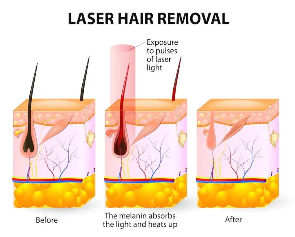 Diode Laser Principle