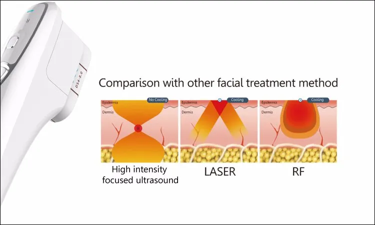 HIFU Handpiece Treatment