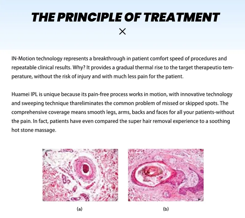 IPL Machine Treatment Handle
