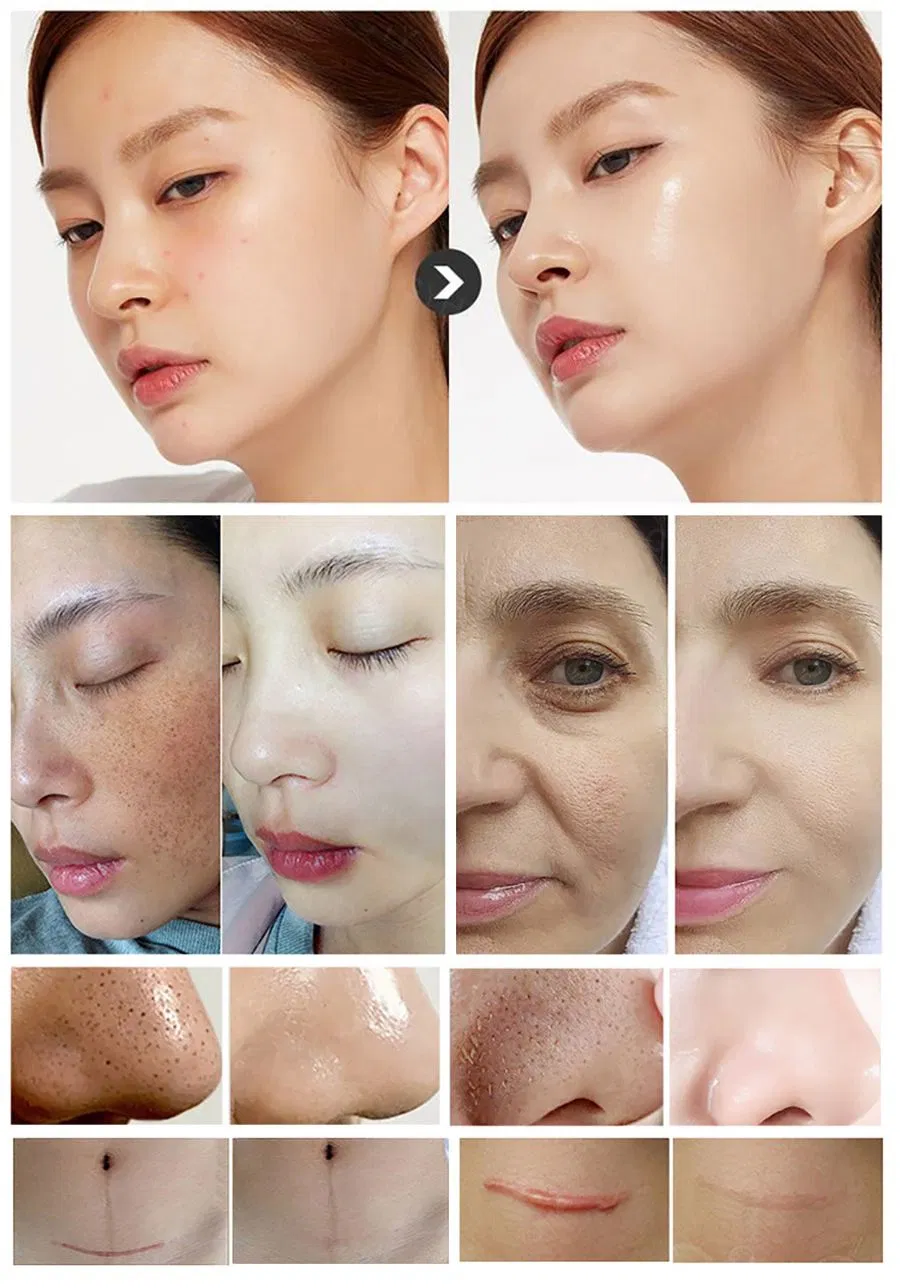 Professional Hifu 22D Max Device for Anti-Aging, Wrinkle Removal, and Face Lifting Treatment