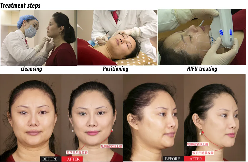 HIFU Before and After Results