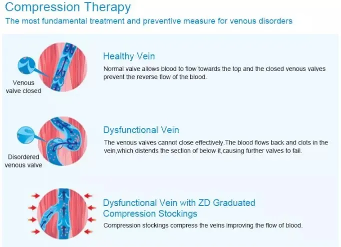 Compression Indication Chart