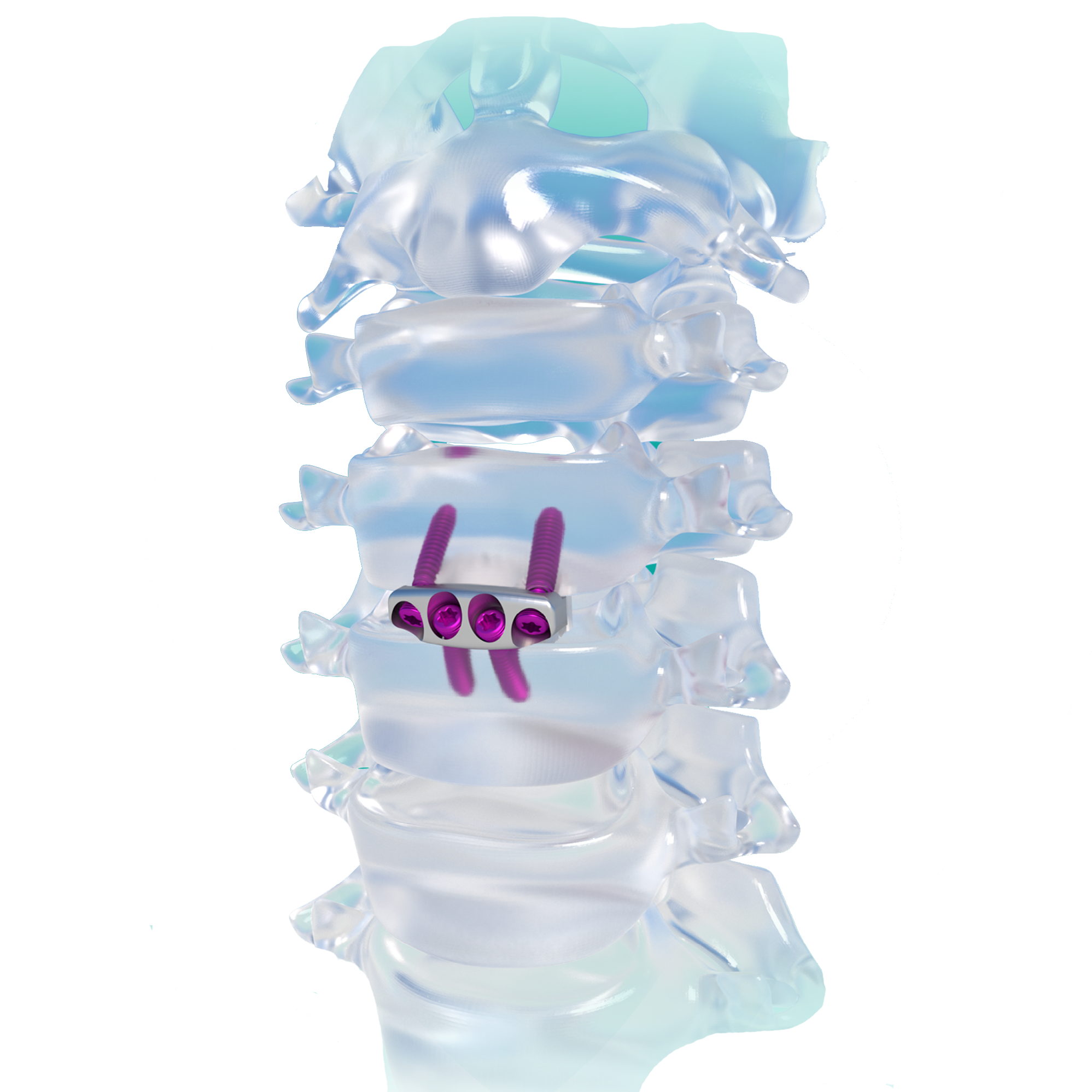Medical Disposable Implants Cervical Spine Fixation Zero Profile Interbody Fusion Cage Four Screws Orthopedic Surgery Titanium