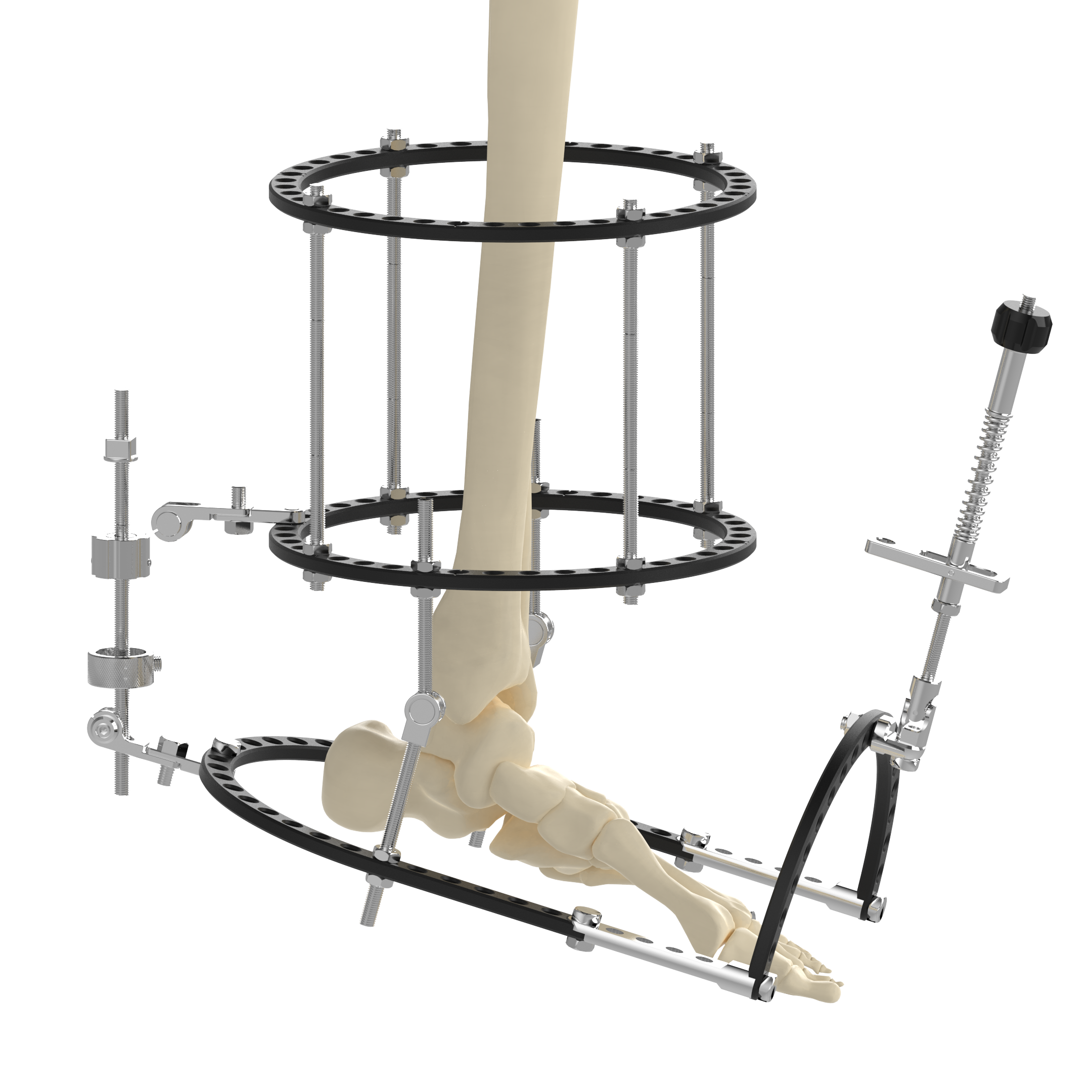 CANWELL Hybrid External Fixator Instrument Set Rod Pin Femoral Linear LRS Compact System Orthopedic CE Bone Implants Class III