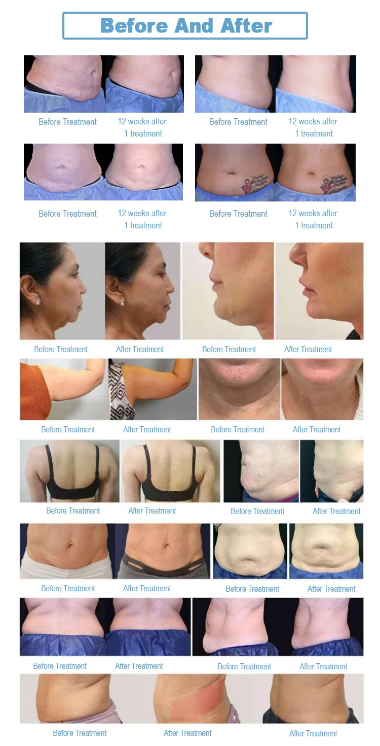 Before and After Treatment