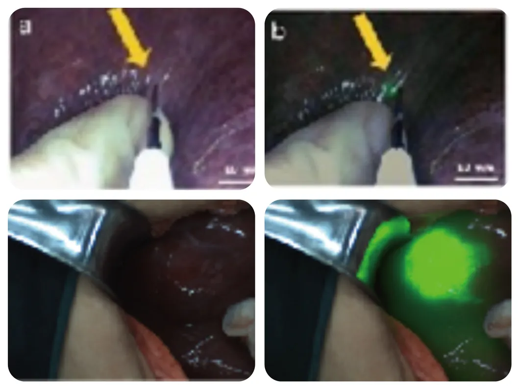 Tumor identification