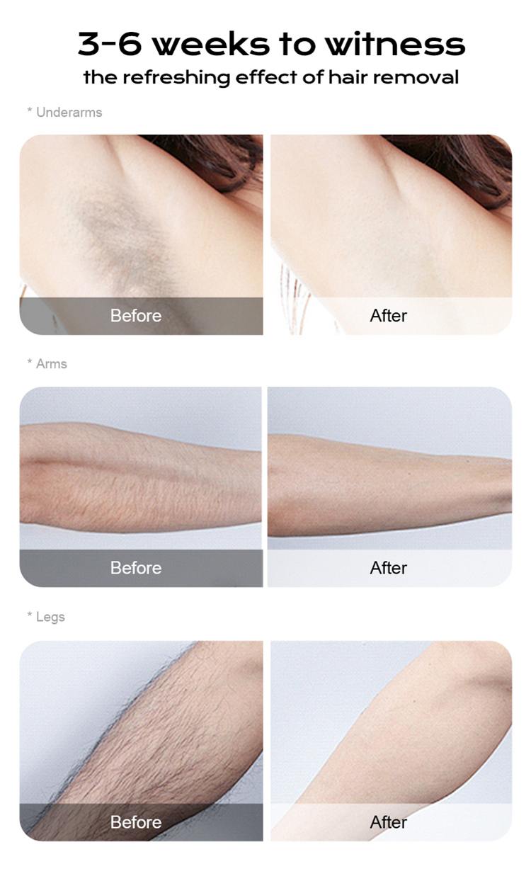 OEM/ODM Medical Laser Epilator Laser Hair Removal Depilation Dual/One Heads Beauty Salon Equipment 1600-2400W CE FDA Diode Laser for Hair Removal Machine