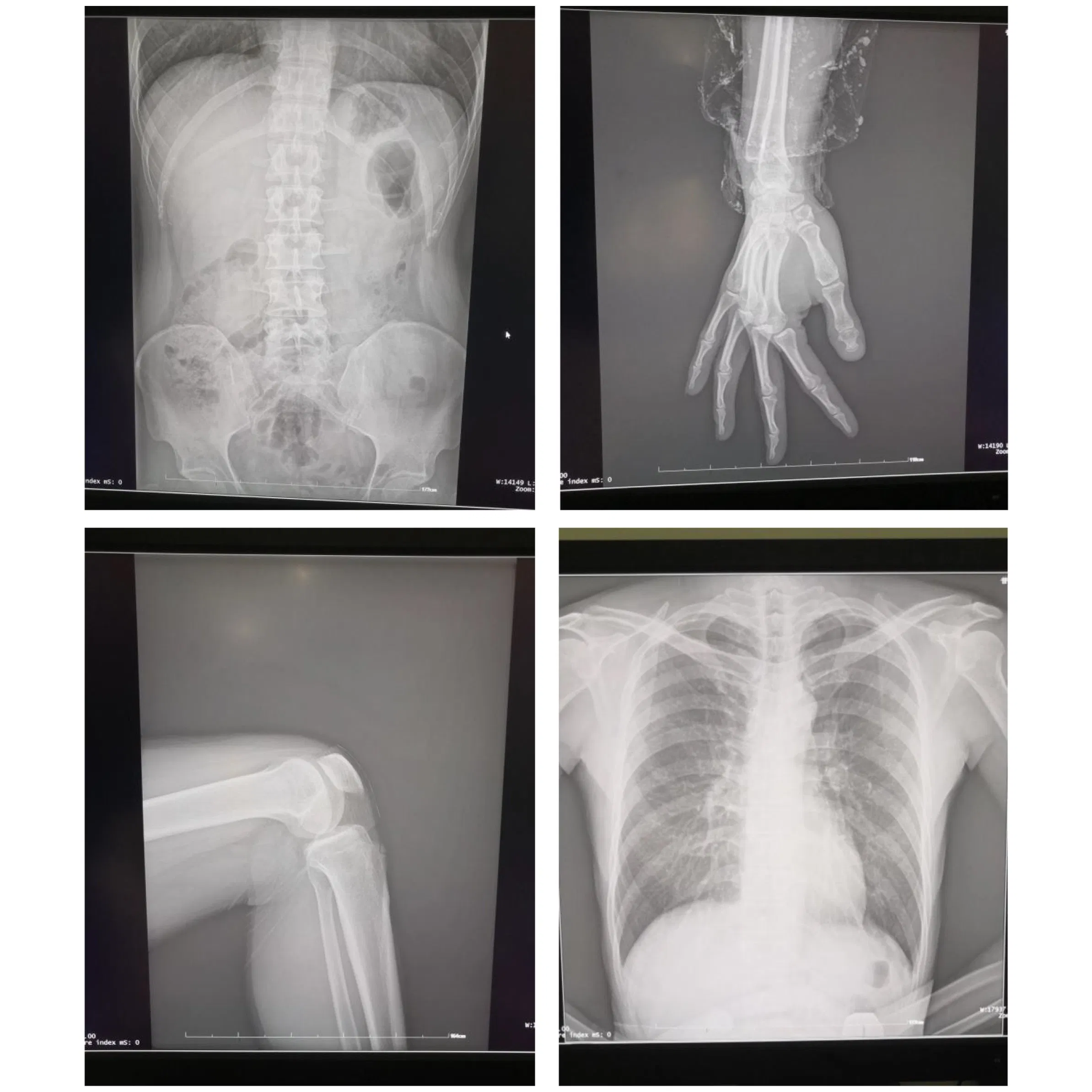 in-D5100 Medical Hospital High Frequency X-ray Equipment Portable Mobile Radiographic Machine Price